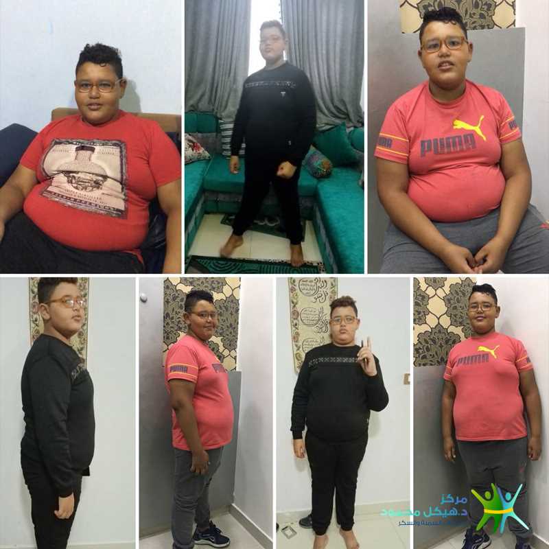 J-shaped Gastric Sleeve for the youngest case in the world