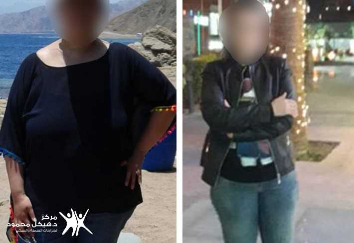 extra weight obesity