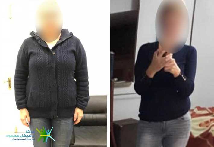 J shaped Gastric sleeve
