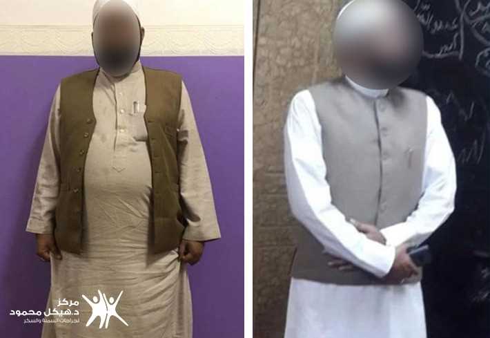 Gastric Bypass Surgery