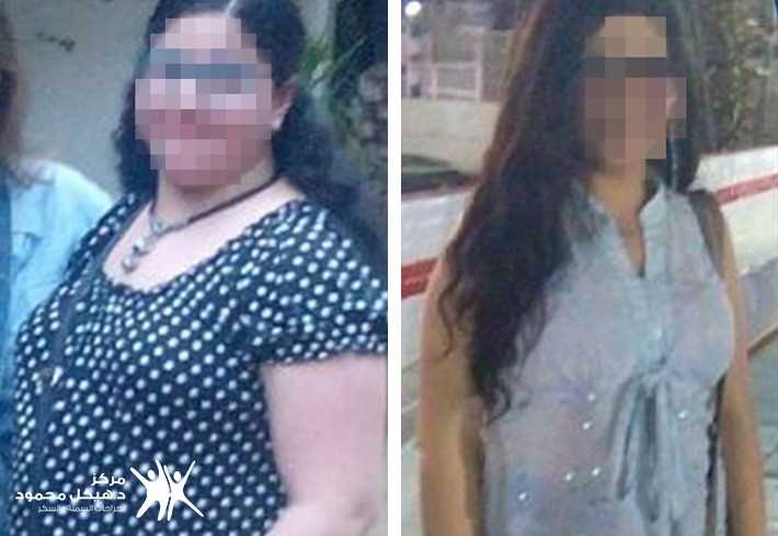 J shape Gastric sleeve